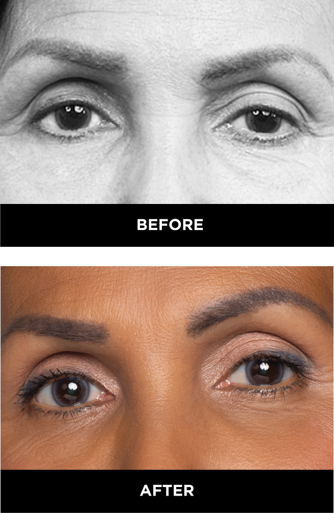 deep set eyes before and after