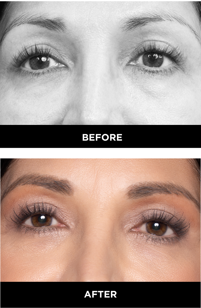 downturned eyes before and after